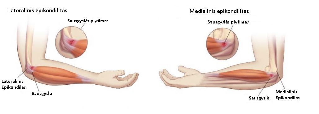 rankos sausgysliu skausmas