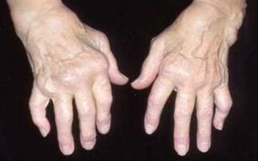 ženklai artritas šepečiai rankos