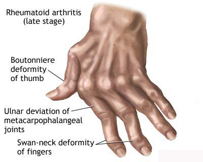 artritas kairėje pirštas 1