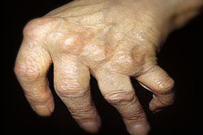 sukelia artritas rankų neurastenia sąnarių skausmas