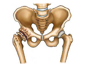 osteoartrito bendrą sąnarių gydymo