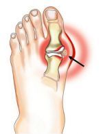 gydymas uždegimas pėdų sąnarių pagalba sąnarių artrozės