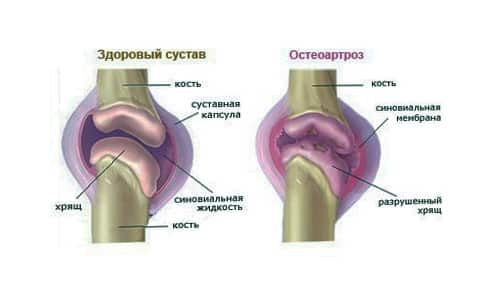 gydymo osteoartrito pėdos