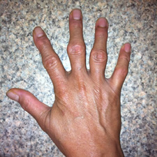 arthrisa artritas rankos kas atsitinka artrozės ir alkūnės sąnario