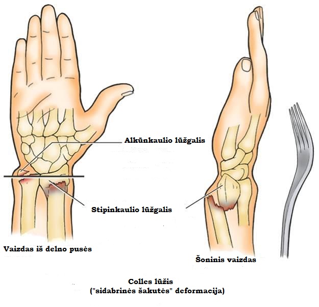 kaires rankos rieso skausmas artrozė paūmėjimas į gydymą