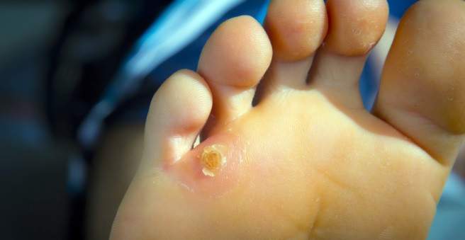kūgis ant pėdų gydymui sąnarių gydymas žaizdos skverbiasi į bendrą