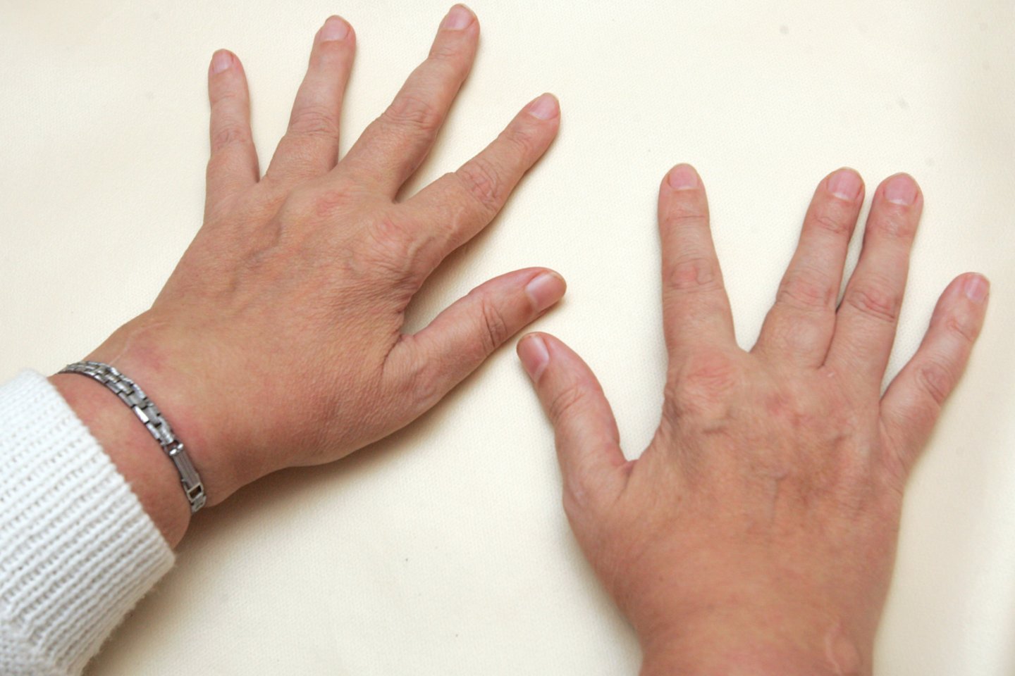 ligos sąnarių liaudies medicinos stiprus skausmas rankas rankų sąnarių