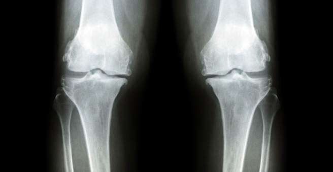 pakuotės tepalas sąnarių artrozės metu pėdos osteoartritas