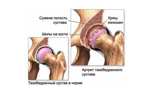 osteoartrito artritu pirštų