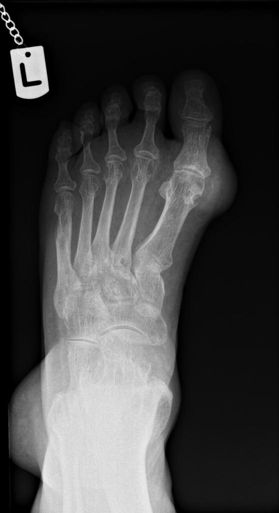 podagra x ray findings skausmo skausmo ženklai