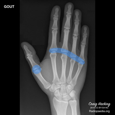podagra x ray findings priežastis artritas pirštų