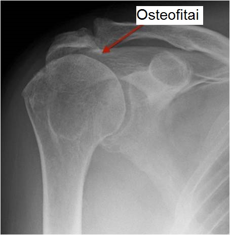pradiniai simptomai osteoartrito pečių sąnarių