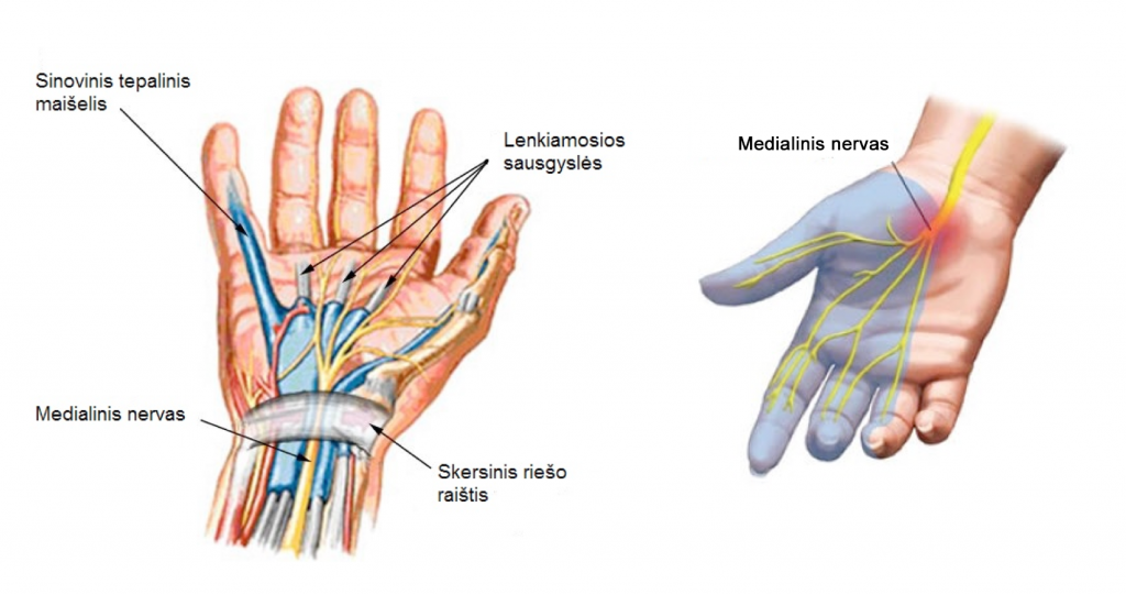 rankos sausgysliu skausmas