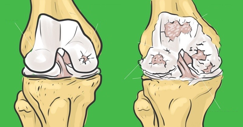 artritas rankos valymo atsiliepimai koju ciurnos skausmai