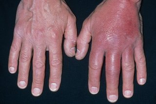 swollen painful finger joint nhs transderminė terapinė sistemos ligų sąnarių