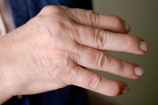 swollen painful finger joint nhs gerklės sąnarių už tą pačią terjeras