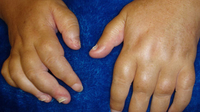 swollen painful finger joint infekcinės ligos sąnarių kaulų