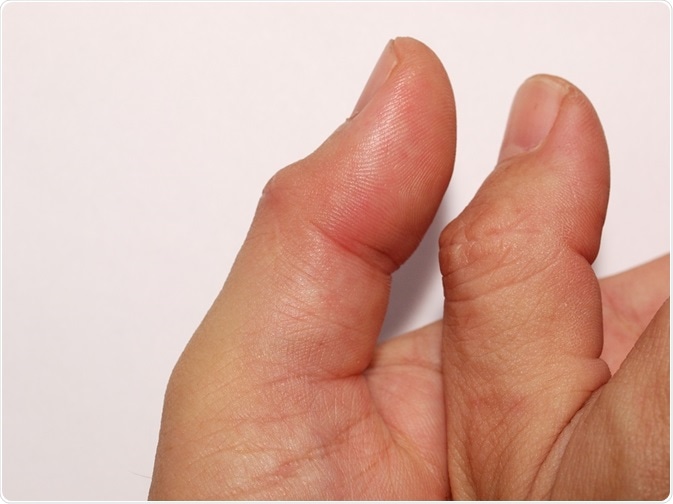 swollen painful thumb joints skauda krutine ir gerkle