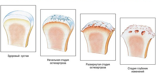 traumes rėminės konstrukcijos sąnario 2 artrozė iš piršto sąnarių