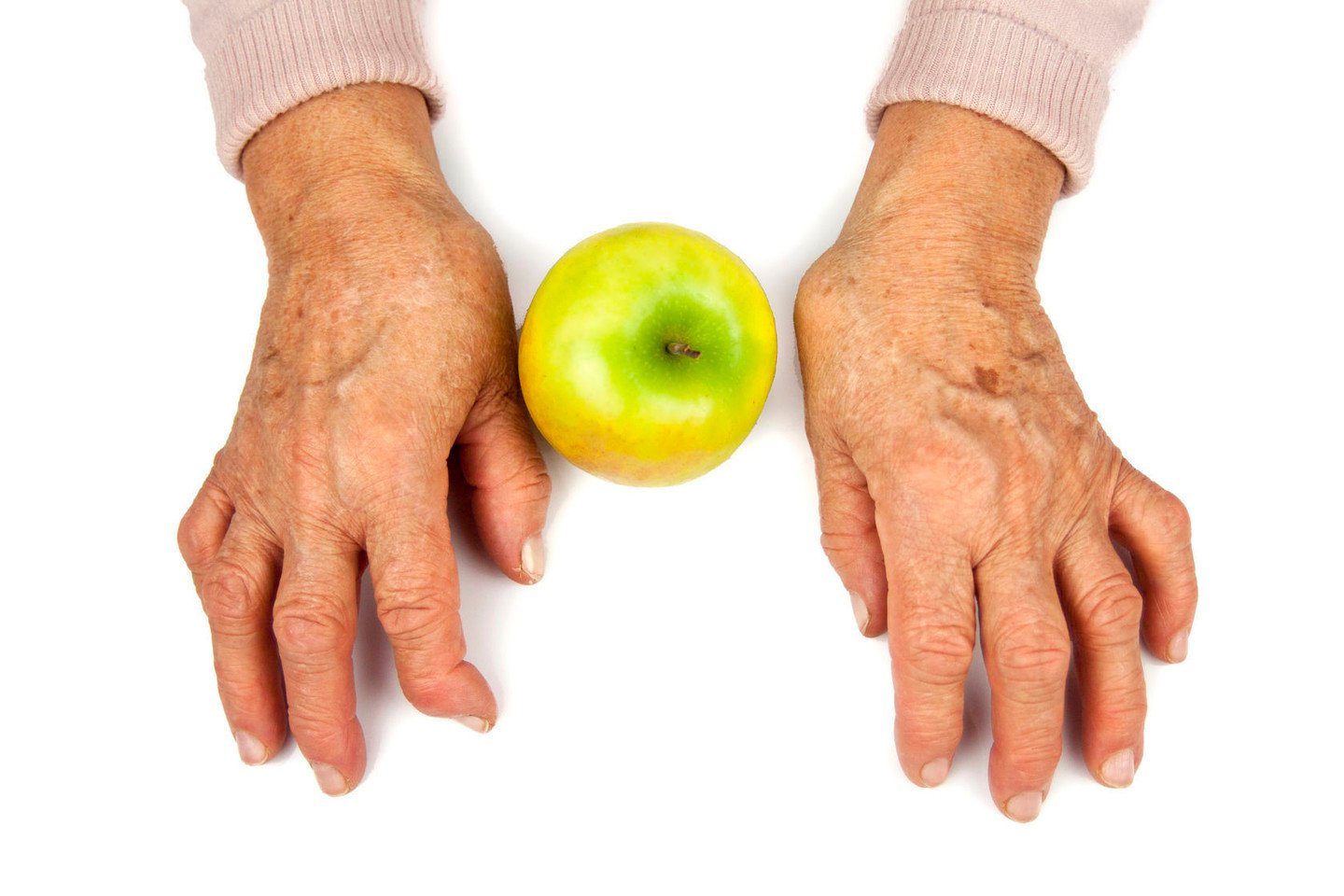 live gydymas arthrisa tepalas nuo arthro active sąnarių