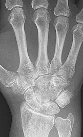 reumatoidinis artritas wiki liaudies gynimo priemonės dėl sąnarių skausmo gydymo