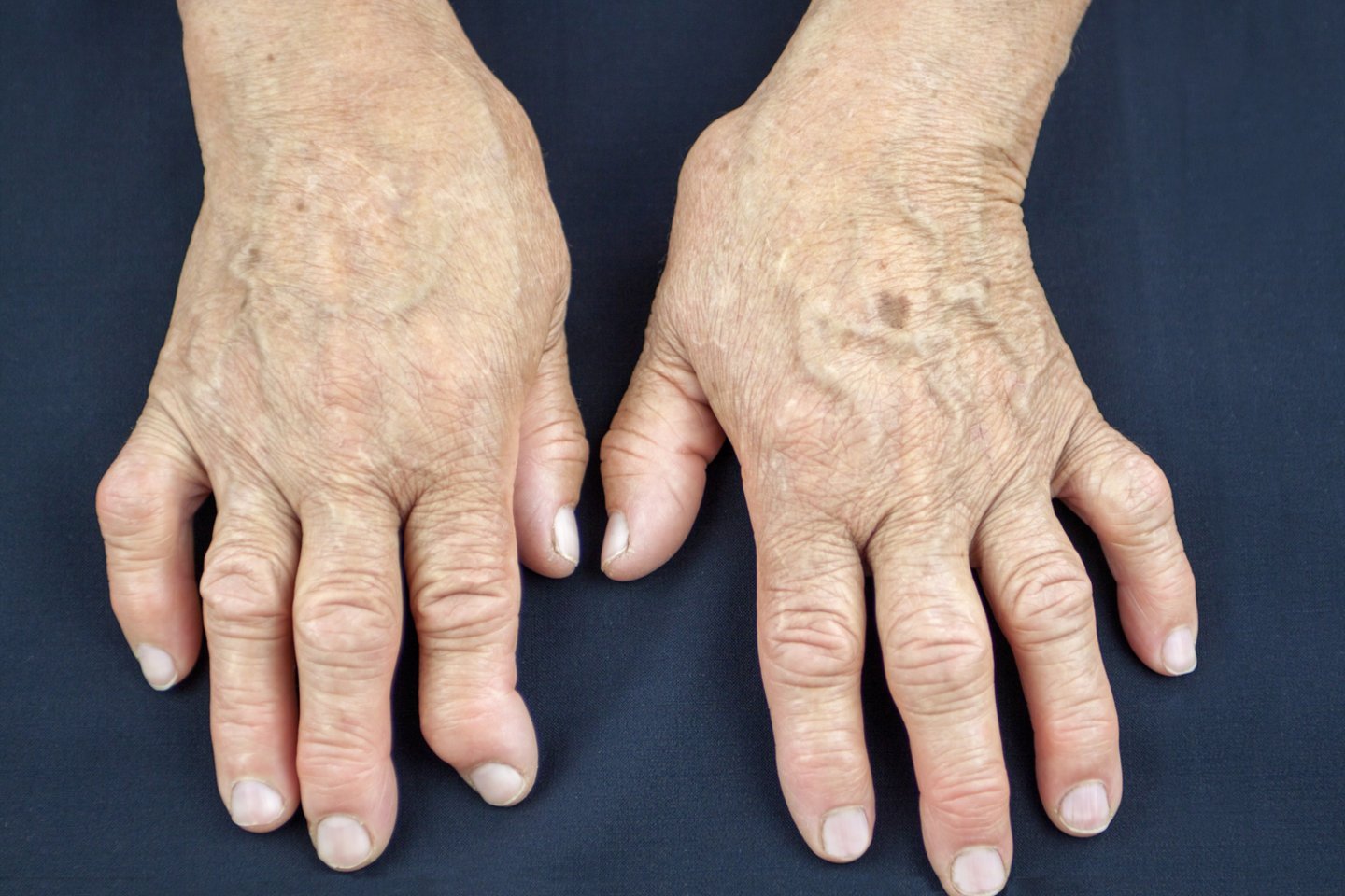 artritas ligų sąnarių