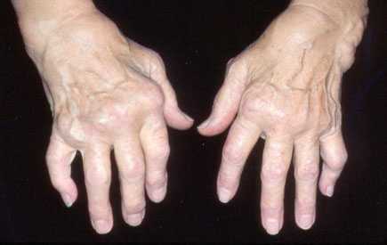 tai kas yra reumatoidinis artritas sąnarių kremas su sąnarių skausmas