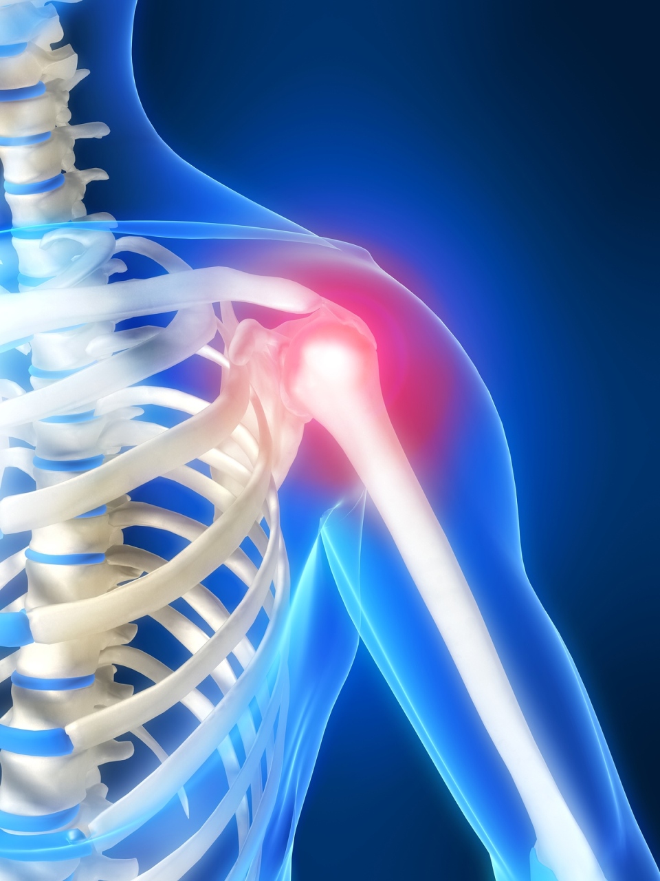 skauda peties sąnario sutrikti osteoartritas pozymiai