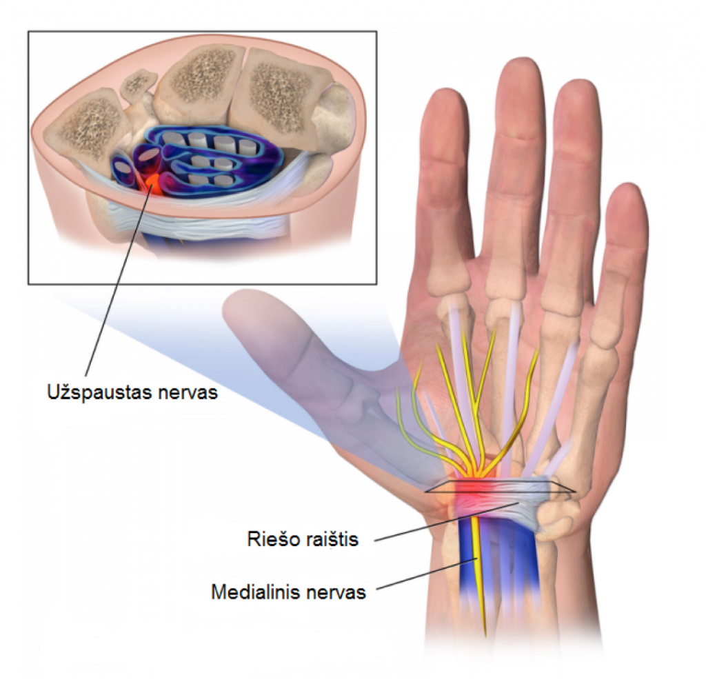 artritas plaštakų rankas kas tai yra igimta klubo sanario displazija