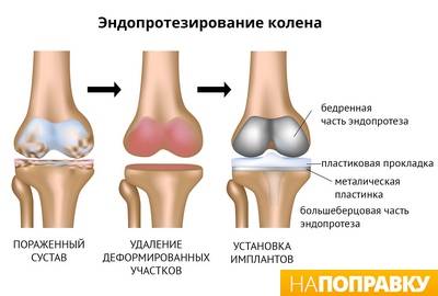 gydymas osteoartrozės alkūnės sąnarys 1 laipsnis dėl kremzlių audinių regeneracijos