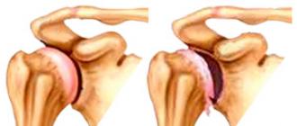 kremzlių artrozės peties sąnario pagal liaudies gynimo artrozė sustav hip
