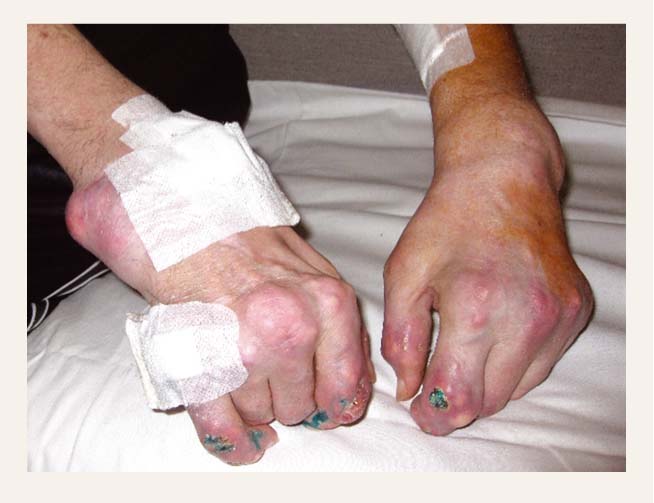 podagra slimība kairio peties ir rankos skausmas