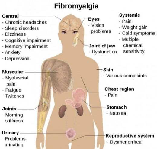 fibromialgija sąrašas tabletes nuo skausmo sąnariuose