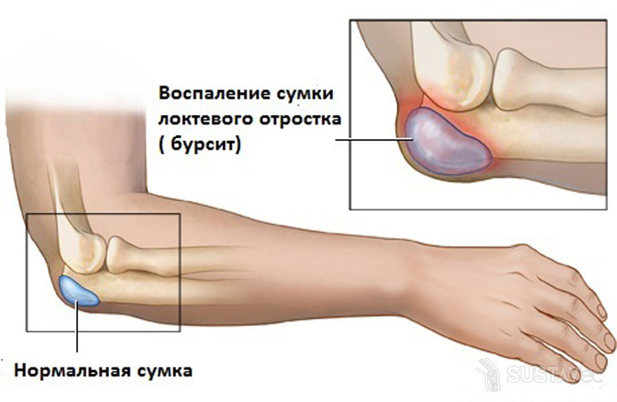 gerklės alkūnės sąnarių abiem rankomis artritas iš šepetėliai rankų sąnarių
