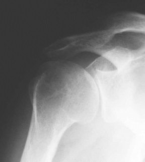 gydymas osteoartrito 2-ojo laipsnio sąnarių skausmas kai sėdi