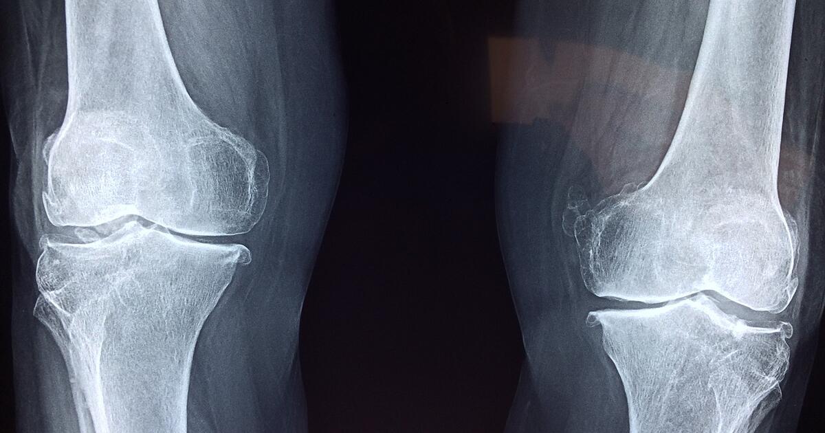 gelis atkurti sąnarių artritas artrito mažų pėdų sąnarių