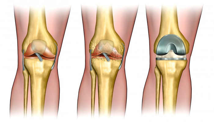 prevencija osteoartrito periferinių sąnarių liaudies gydymas iš skausmas pirštų sąnarių